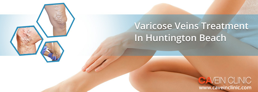 varicose veins treatment 